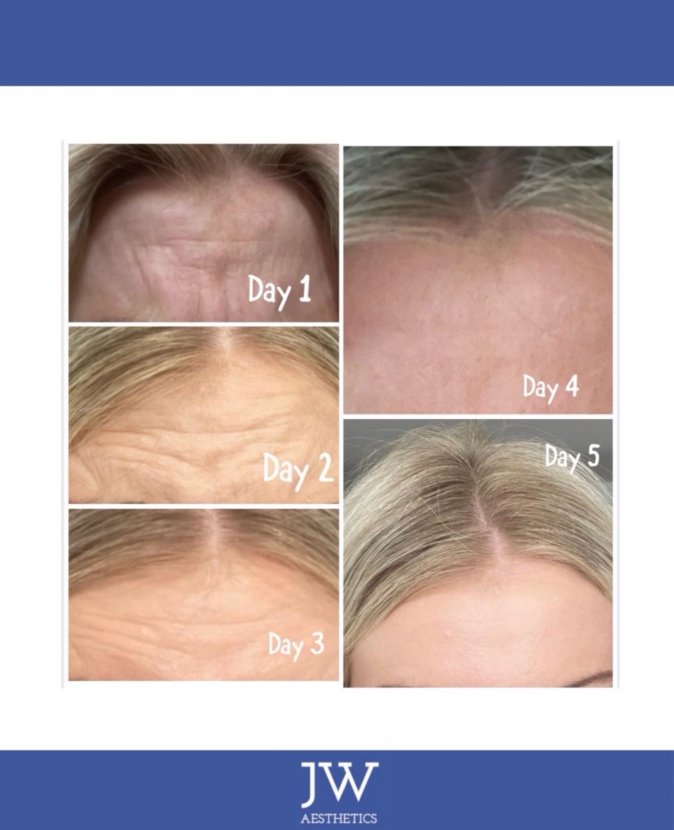 Anti-wrinkle forehead lines - Day 1 to Day 5 progression