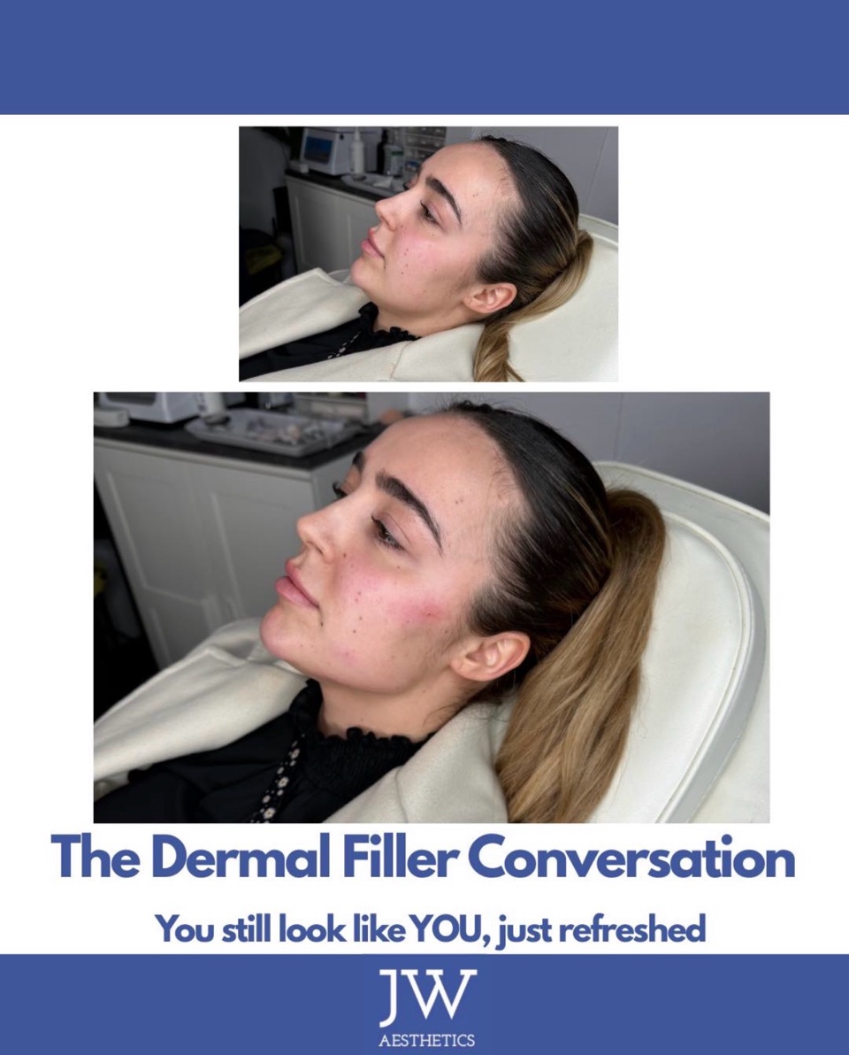 Dermal filler jawline before and after