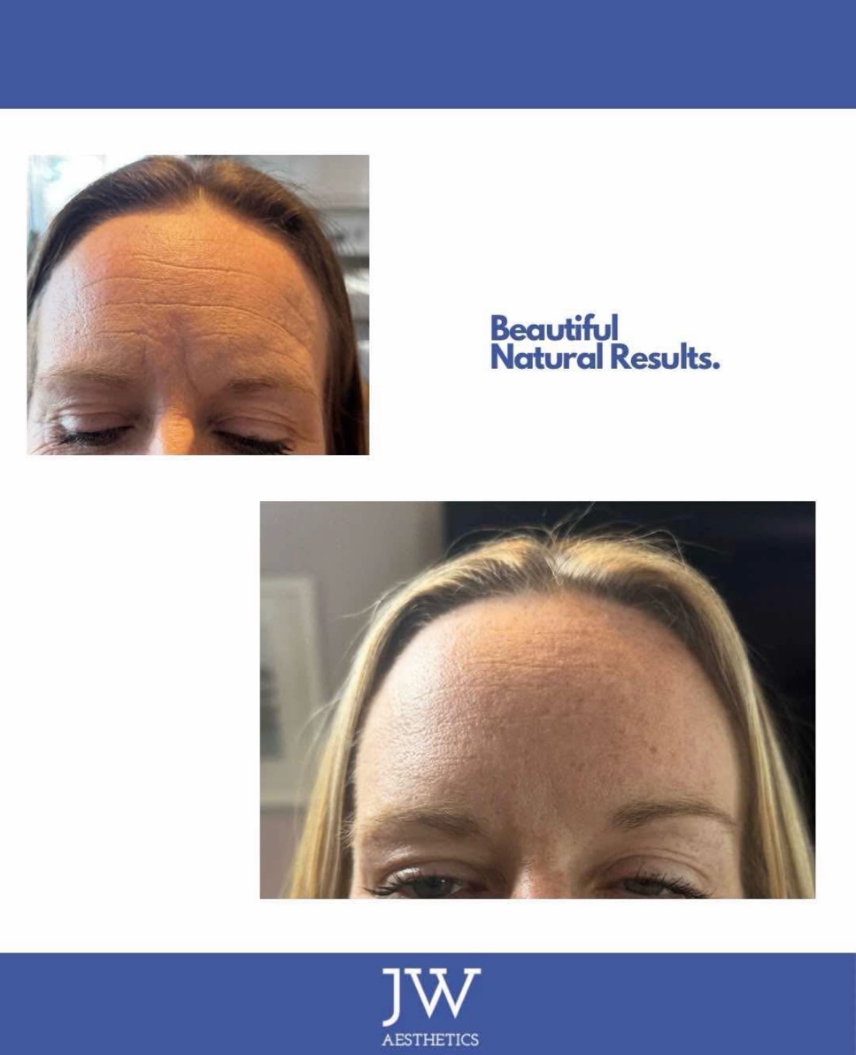 Anti-wrinkle forehead before and after