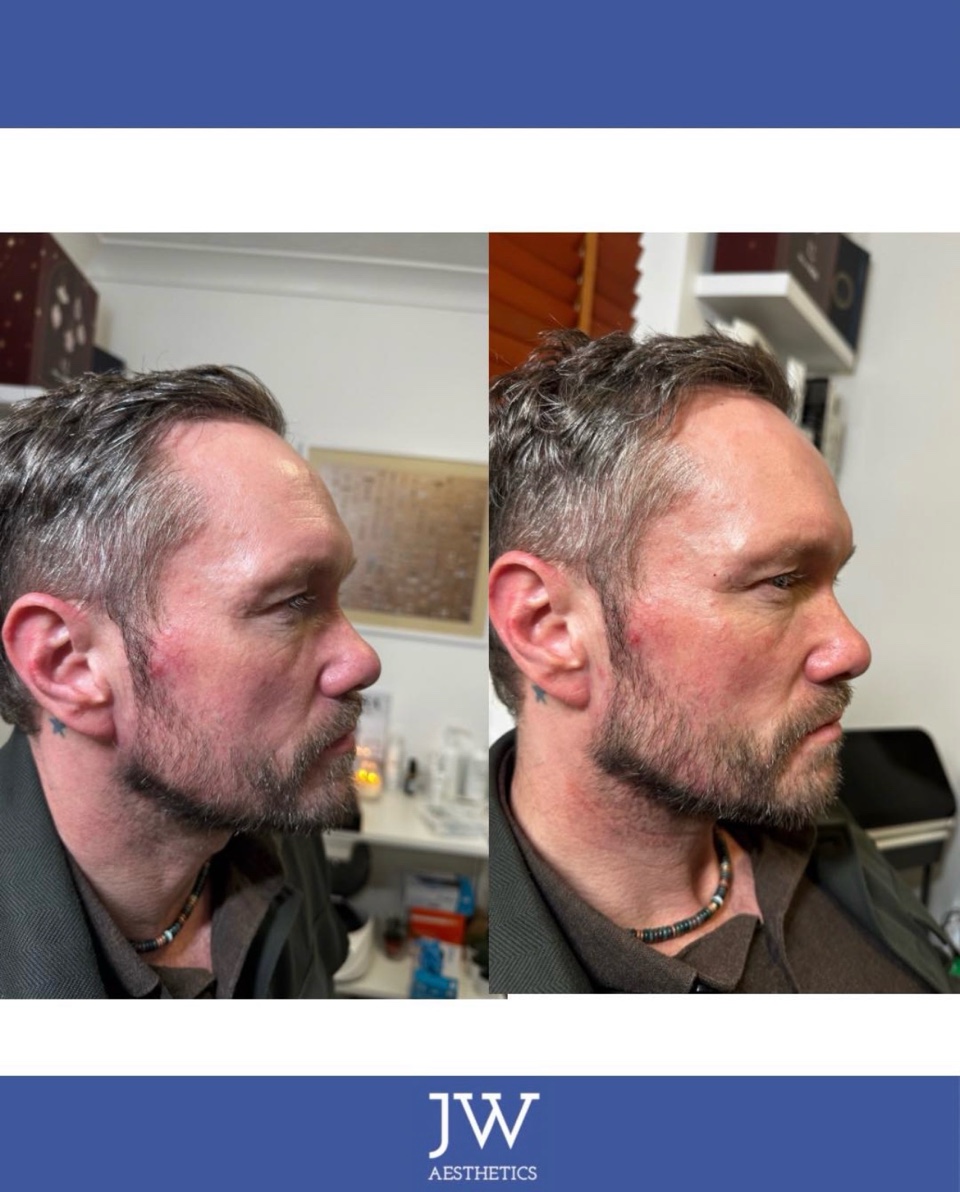 Dermal filler jawline male before and after