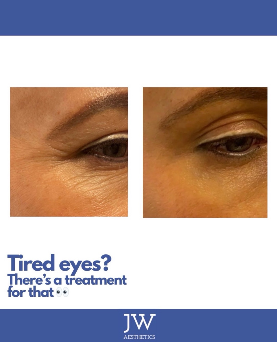 Crow's feet and under eye before and after