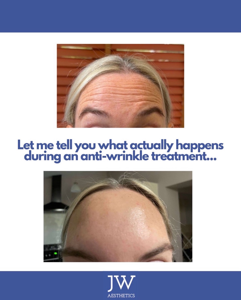 Anti-wrinkle forehead before and after