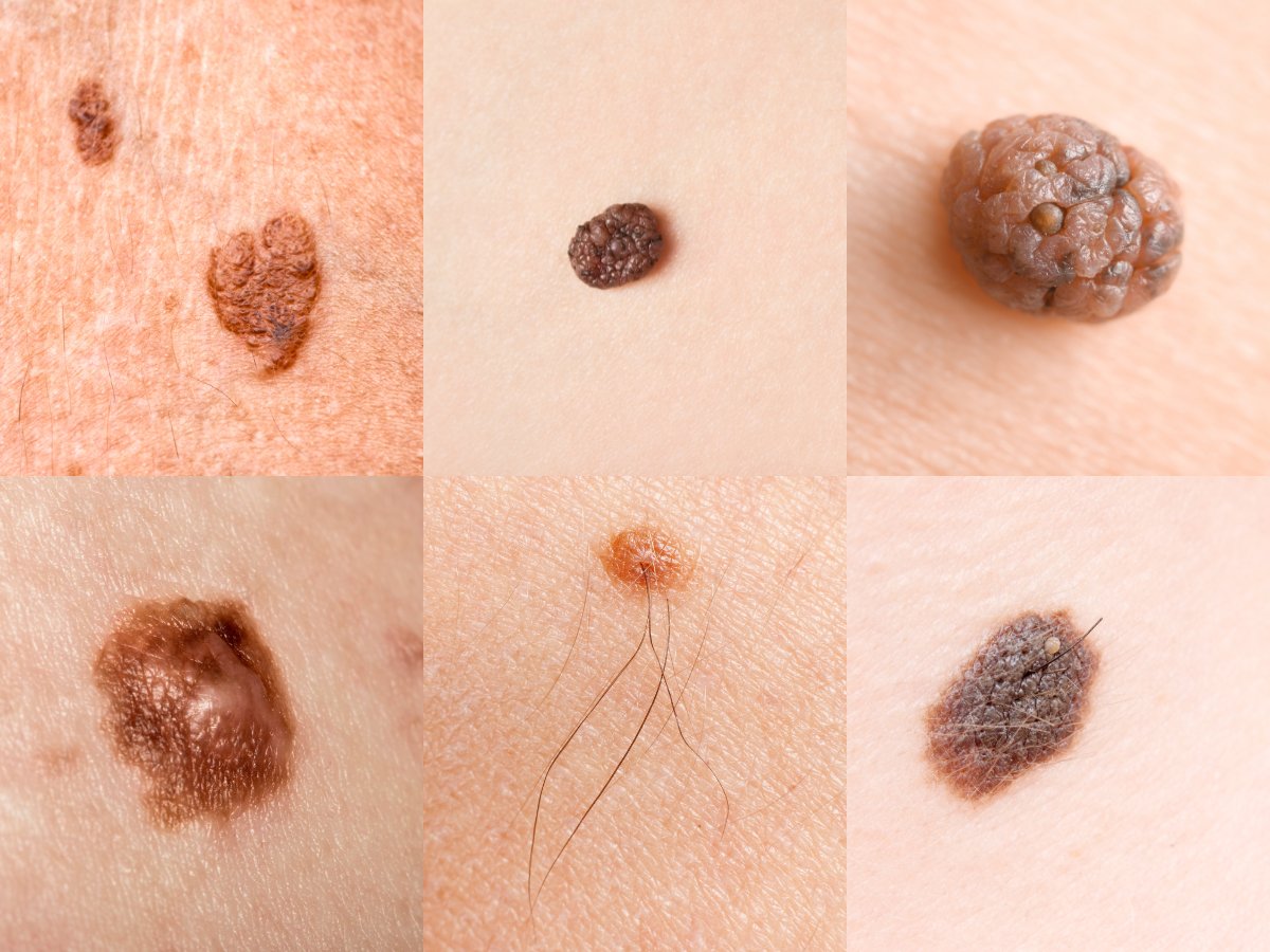 Different types of moles and skin lesions