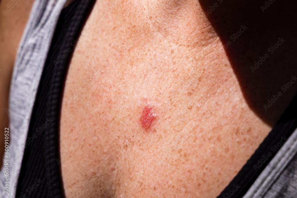 Skin lesion assessment